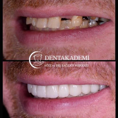 Sonrisa de Hollywood Foto antes/después